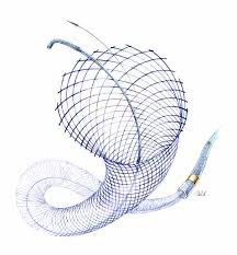 Stents diversores de flujo